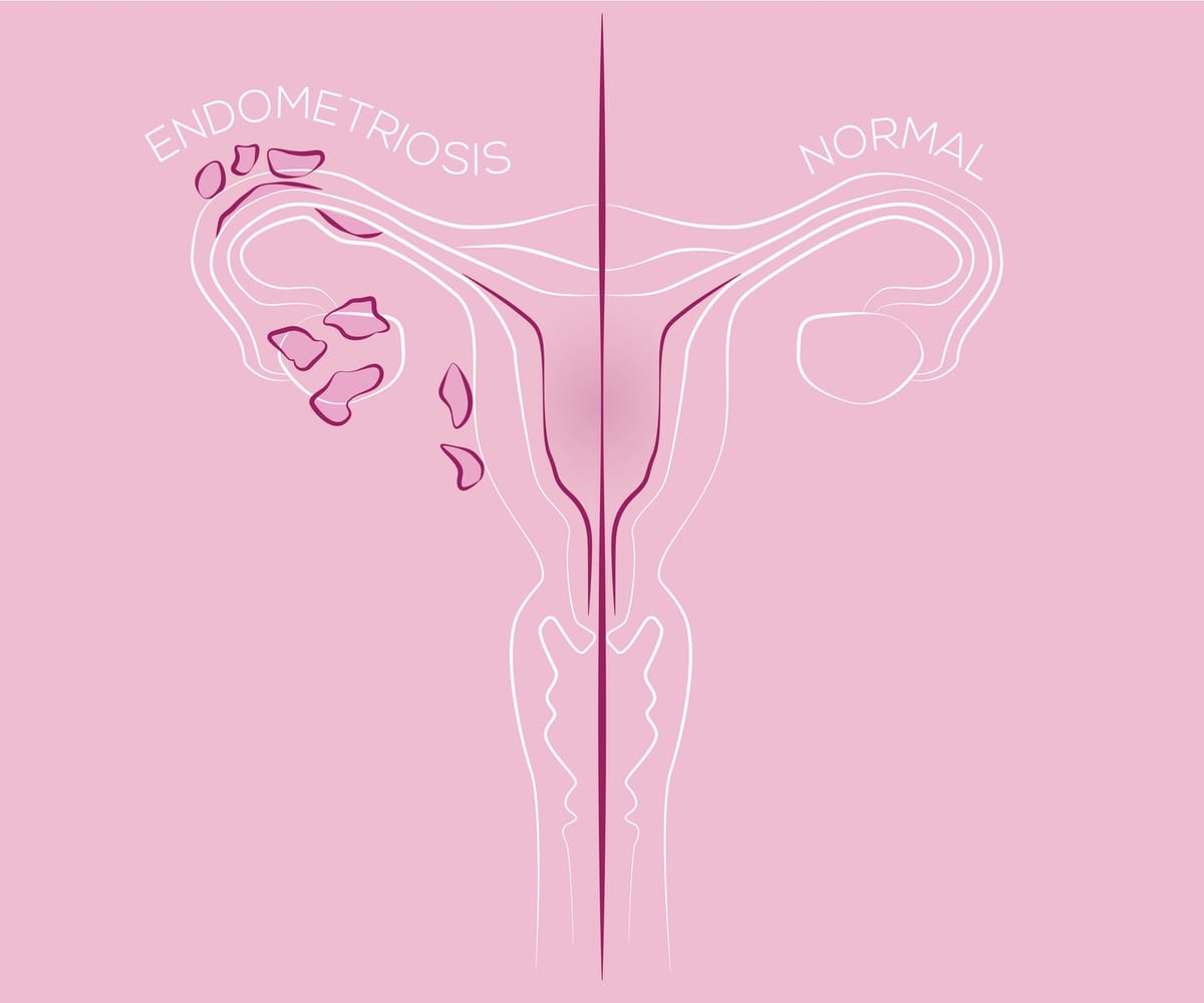Schéma d'appareil reproducteur féminin avec ou sans lésions d'endométriose